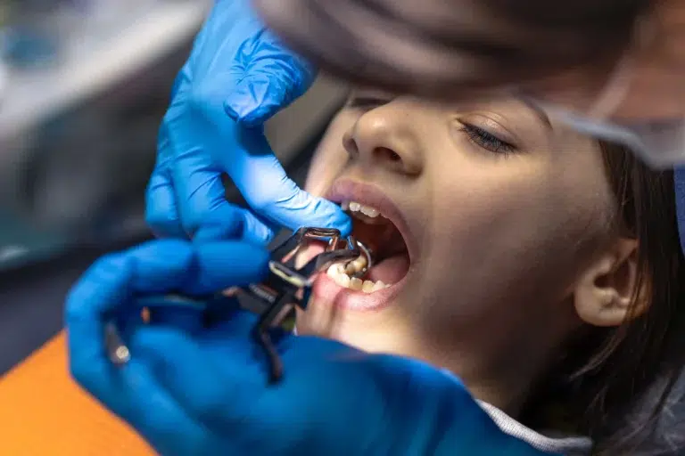 Caries Dentales Y Su Prevención En La Clínica Dental En Las Rosas San Blas barbara lizaur